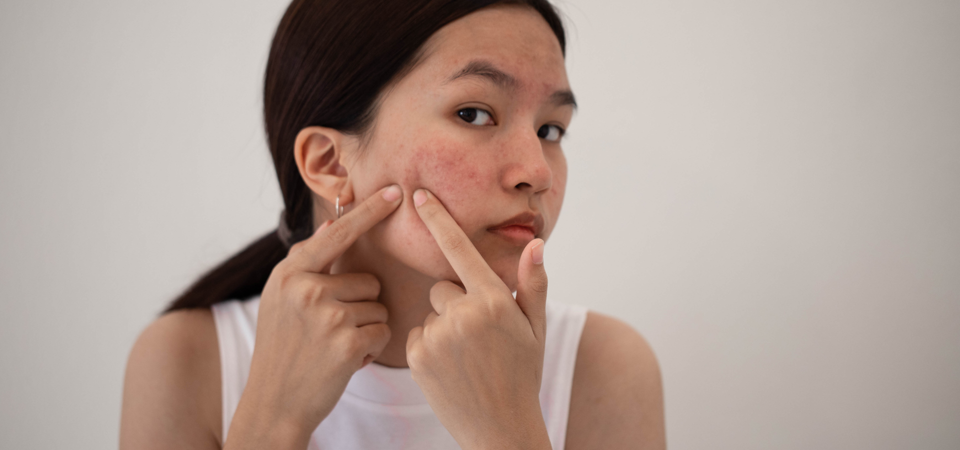 Tenangin Pikiran, Tenangin Kulit: Lawan Jerawat Akibat Stres